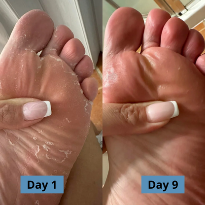 Micovia® AntiFungal Relief Soap Bar