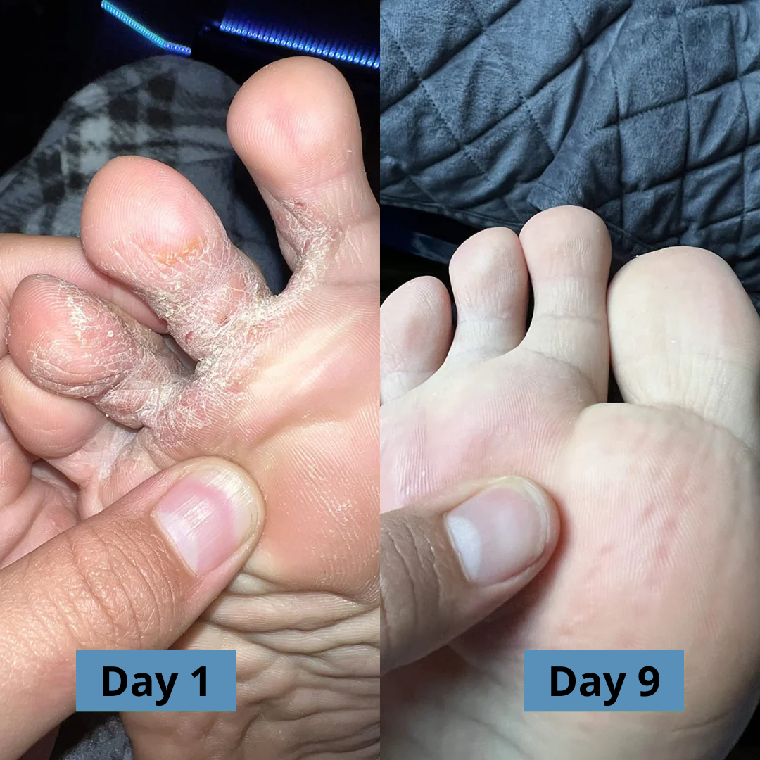 Micovia® AntiFungal Relief Soap Bar