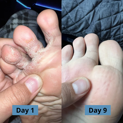 Micovia® AntiFungal Relief Soap Bar