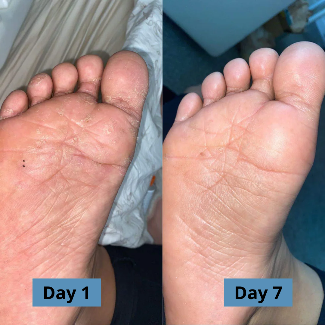 Micovia® AntiFungal Relief Soap Bar