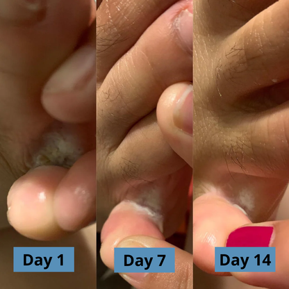 Micovia® AntiFungal Relief Soap Bar